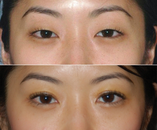 Asian Eyelids Surgery 21
